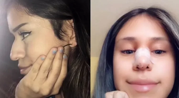 Obligó a su infiel novio a pagarle la rinoplastia Obligó a su infiel novio a pagarle la rinoplastia